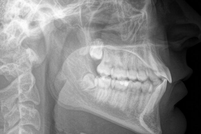 Kieferorthopädie Röntgenbild 2
